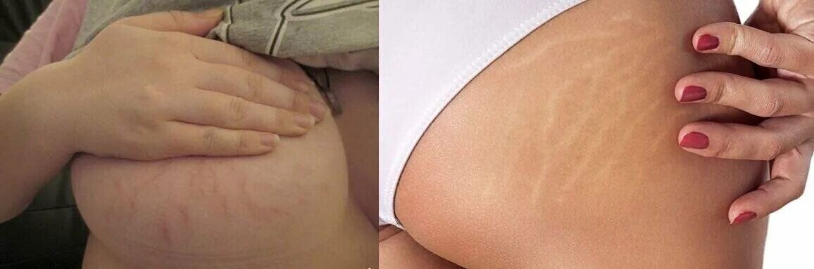 skin tags during pregnancy